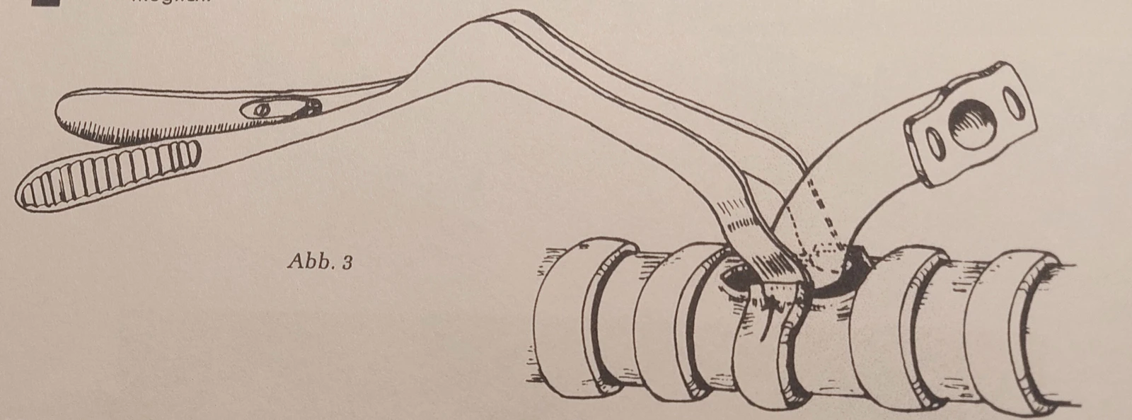 Zeichnung zur Anwendung des Spreizspekulums an der Trachea.